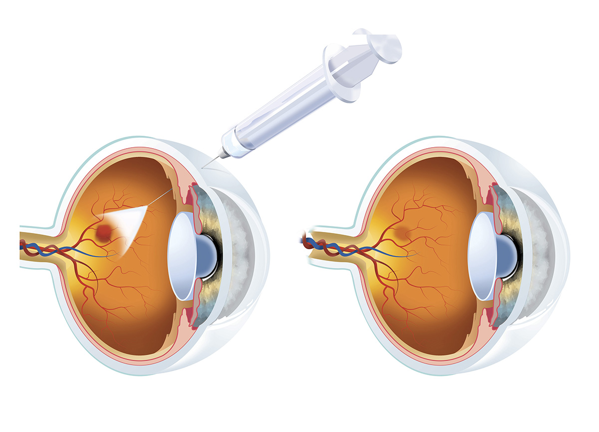 macular-degeneration-symptoms-causes-and-treatment-college-review